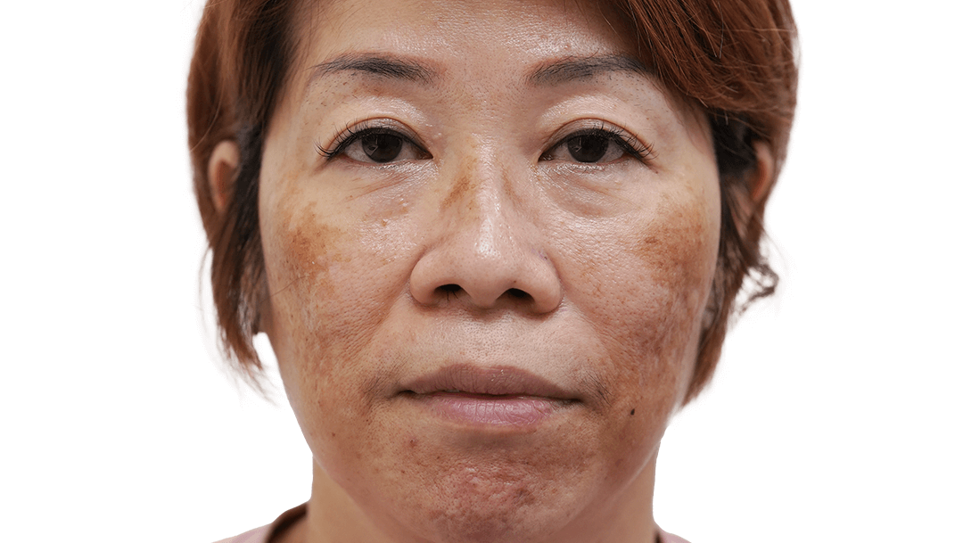 LP-comparison-01-melasma-before